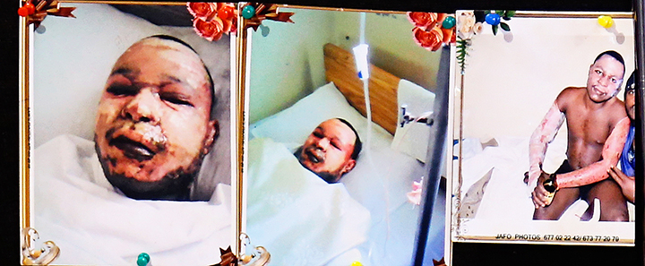 mr-mbangsi-emile-suzeh-severe-fire-burn-injure-a-w-1